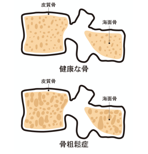 骨粗鬆症と通常の骨